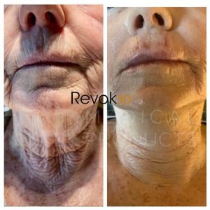 THR-Revok50-1-syringe-neck-1-syringe-perioral-area.-2-sessions